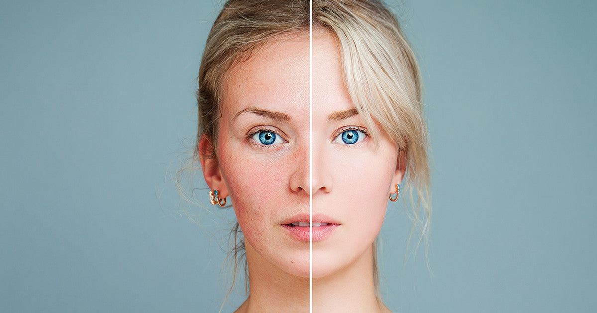 Helia-D Webáruház - Főszerepben a vadgesztenyés krémek rozácea ellen