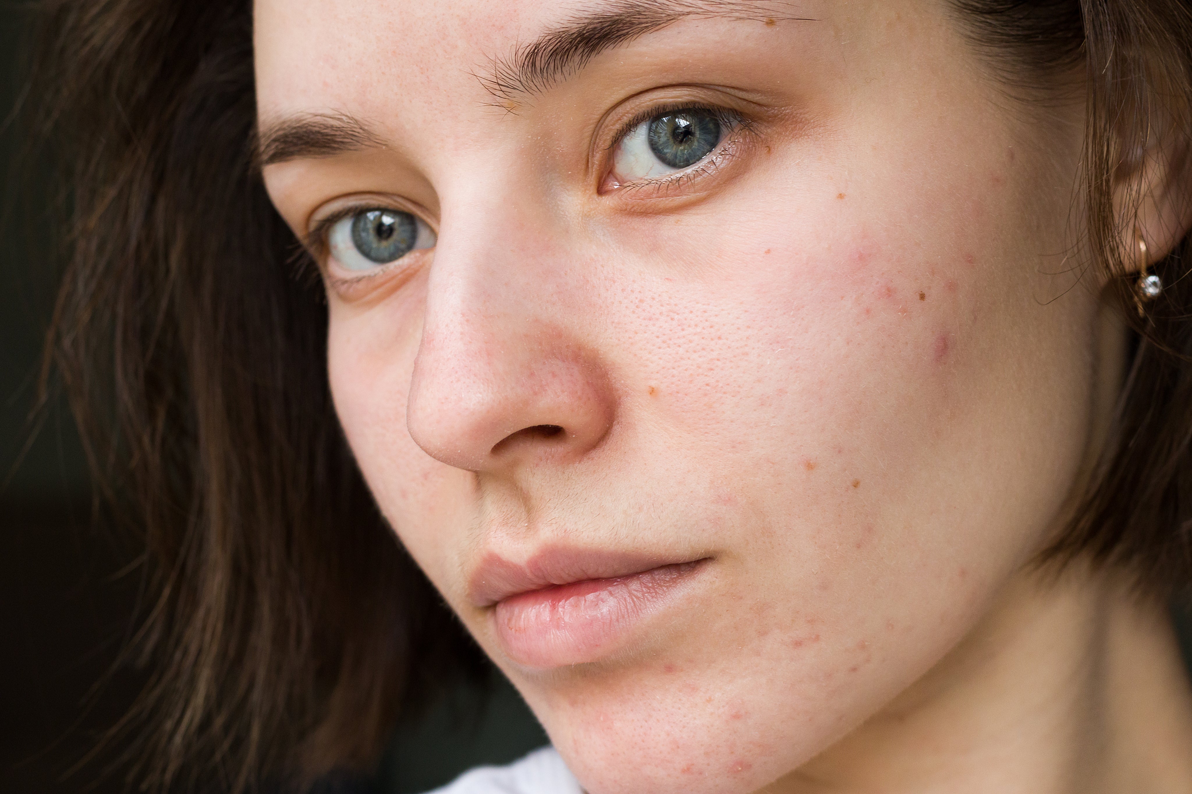 Zsíros, pattanásos